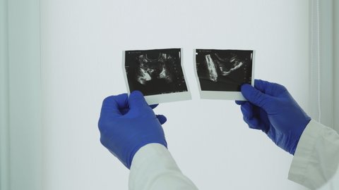 An ultrasound scan of the prostate, in the hands of a doctor, an ultrasound of the prostate gland, an analysis for prostate disease is done by the doctor.