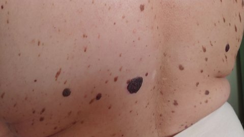doctor dermatologist inspecting large wart nevus with ruler, checking size of a biggest growth, scale of birthmark. 4k closeup macro video footage.
