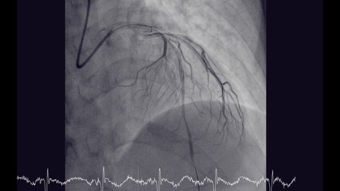 Cardiac catheterization showing coronary arteries for diagnosis cardiac arrest .