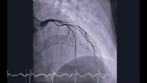 Coronary angiography is a test used to find out how much narrowing there is in coronary arteries for detect cardiac arrest ,Showing left coronary artery.