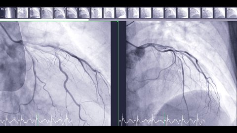 Coronary angiography is a test used to find out how much narrowing there is in coronary arteries for detect cardiac arrest ,Showing left coronary artery.