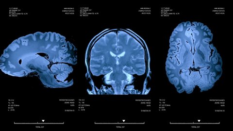 MRI brain scan screen animation. Diagnosis medical data.