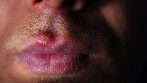 Herpes Simplex Virus (HSV) Mouth Infection.
herpes simplex virus type 1.
herpes simplex labialis.
fever, infectious disease. 
Herpes labialis.
cold sores.
Human alphaherpesvirus 1.
viral infections