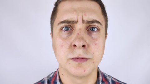 Acne and black dots close-up. The man looks in the mirror and sees acne there. Skin care concept, consequences of food allergy or insect bites