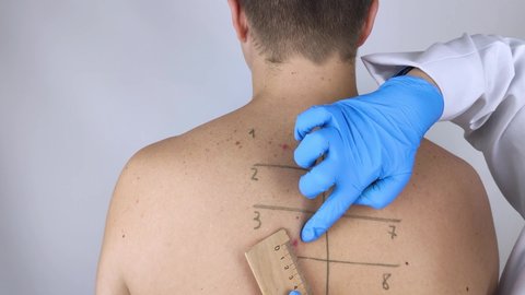 An allergist or dermatologist examines red spots on a man’s face. The male suffers from a rash, hives and itching. Food Allergy, Insect Bite, Measles or Chicken Pox. Measuring rash with a ruler