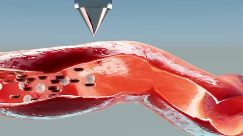 Hemostasis. Red blood cells and platelets in the blood vessel. Basic steps of wound healing process. animation. 3d render. cross section