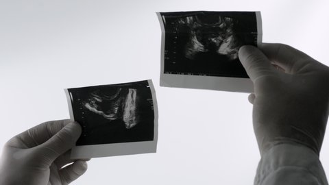 Ultrasound of the prostate on a white background, a picture of a male prostate in the hands of a doctor