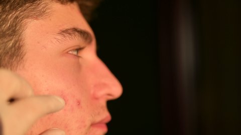 Close up shot of the face of a Caucasian boy in puberty as a hand with a latex glove examines the skin, focusing on boils and red dots.