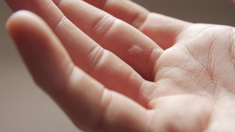 Hand with wart man skin closeup