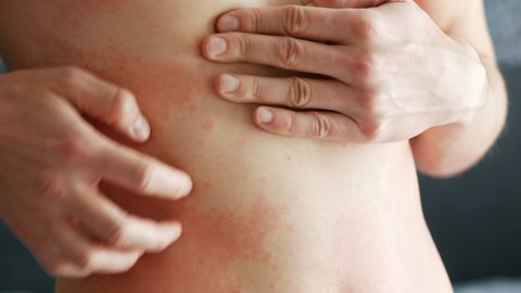 Close-up man scratches a red rash on his stomach in close-up. Allergies and skin diseases