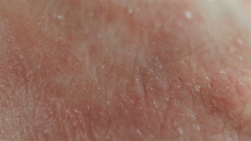 Atopic dermatitis from stress, allergies, fungal or bacterial infection, systemic lupus erythematosus, autoimmune processes. Red spots of the affected epithelium, severe itching, scabies. The affected Royalty-Free Stock Footage #1062177253
