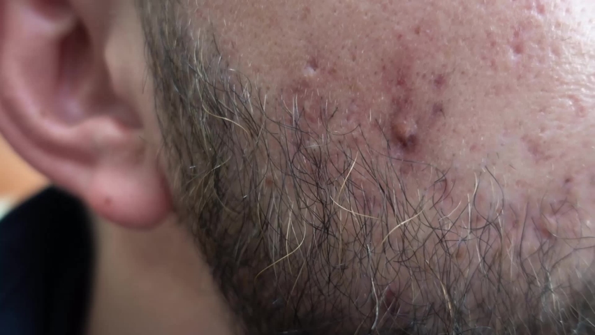 Close up on man face with problematic skin on his cheeks. Bearded young adult with acne problems. Redness, puffiness and pustules. Face inflammation on skin caused by allergy problems. | Shutterstock HD Video #1062212659