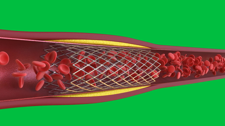 3d Rendering Balloon Angioplasty Procedure Stock Footage Video 100 Royalty Free 1062369451 Shutterstock