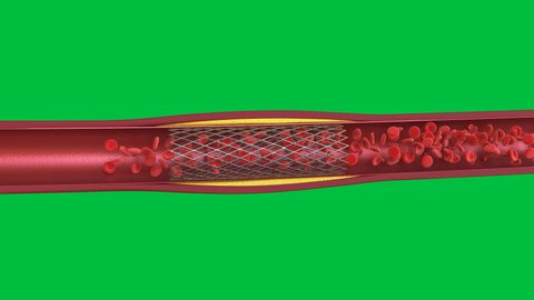 3d rendering balloon angioplasty procedure with stent in vein isolated on green screen 4k footage
