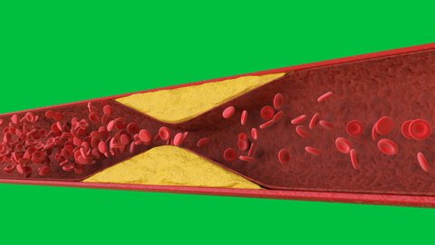 3d rendering atherosclerosis with cholesterol blood or plaque in vessel cause of coronary artery disease on green screen 4k footage