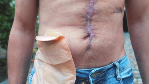 Scars on a man's body after surgery. Pouche and the stick-on appliances for colostomy routine care. The aftermath of police rubber bullets during the protests. Medical device.