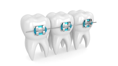 Teeth with dental orthodontic braces
