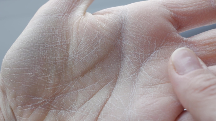 Very dry, cracked skin on the palm, problem skin, dermatological treatment is necessary. close-up | Shutterstock HD Video #1062636967