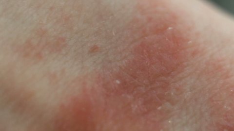 Red spots of the affected epithelium, severe itching, scabies. Atopic dermatitis from stress, allergies, fungal or bacterial infection, systemic lupus erythematosus, autoimmune processes. The affected
