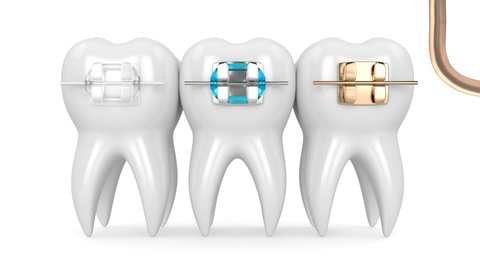 Teeth with three types of orthodontic braces