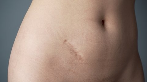 Video Woman Appendectomy Scar On Grey Stock Footage Video (100% Royalty ...