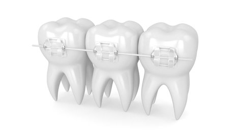 Teeth with clear orthodontic braces