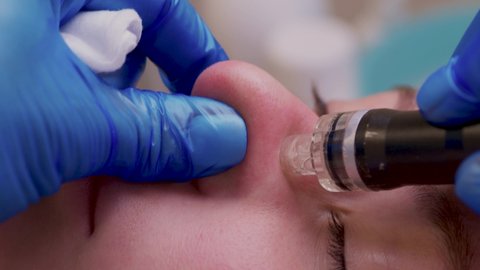 Woman cleaning nose skin pores using vacuum blackhead remover, cosmetic procedure.
