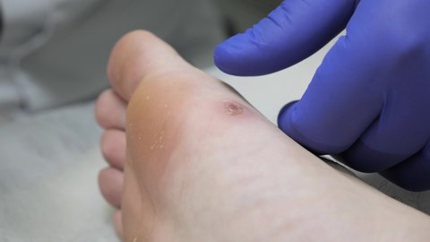 Podology Treatment of viral warts on the male foot in a cosmetology clinic