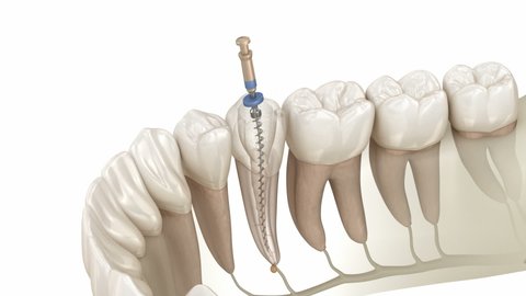 Endodontic root canal treatment process. Medically accurate tooth 3D animation