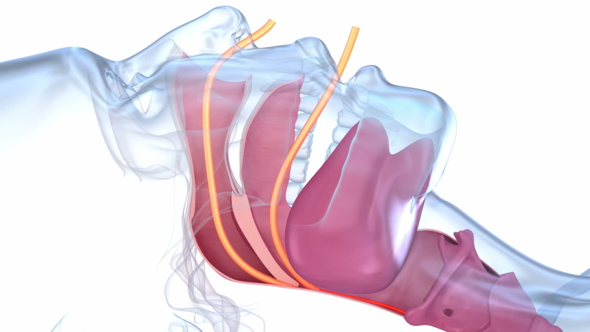 Sleep apnea syndrome. Labeled nasal tongue blocked airway, 3D animation