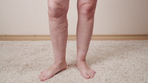Patients legs of an old woman. Varicose veins on a female legs. Phlebology. Close up varicose veins on the leg.