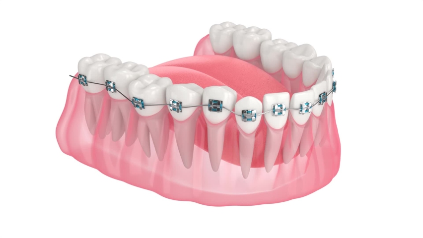 Teeth alignment by orthodontic braces isolated over white background | Shutterstock HD Video #1063295047