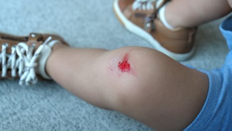 Close up Abrasion Wound on Toddler's Knee.