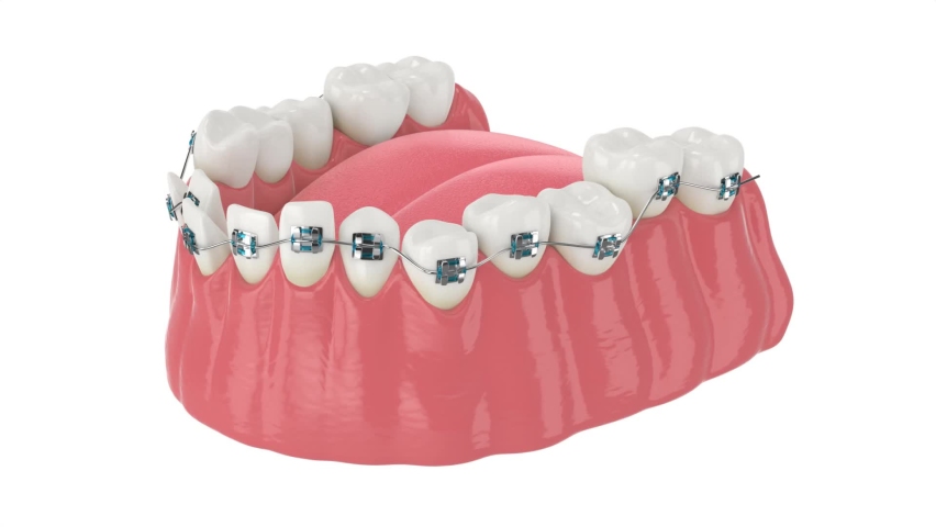 Teeth alignment by orthodontic braces isolated over white background | Shutterstock HD Video #1063454794