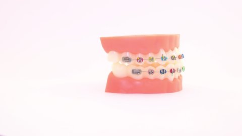 colorful  brackets at teeth isolated on a white background