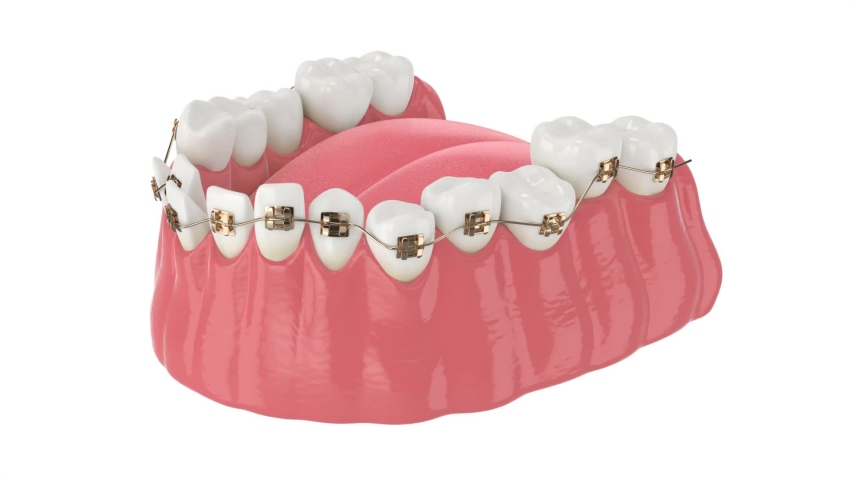 Teeth alignment by golden orthodontic braces isolated over white background | Shutterstock HD Video #1063548346