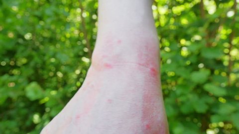 wrist with several insect/ mosquito bites and scratch marks/ skin lesions