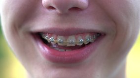 Closeup view 4k video of young kids face smiling. White teeth with dental braces. Boy of 13 years old.
