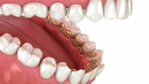 Lingual braces system, bite correction. 3D animation concept of golden braces