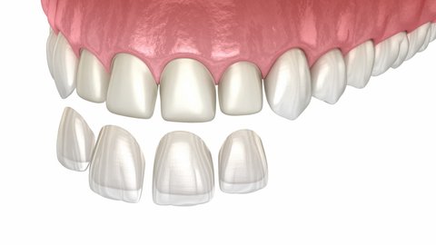 Dental Veneers placement over teeth. Medically accurate tooth 3D animation