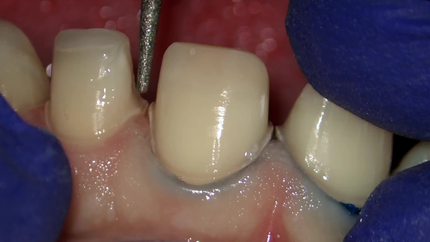 tooth preparation for precc ceramic crown Royalty-Free Stock Footage #1063790515