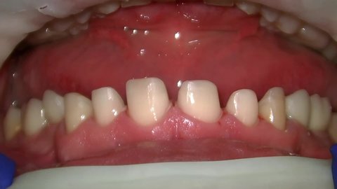 press ceramic crowns try in