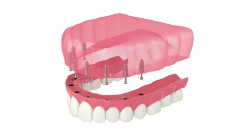 Removable snap-on full implant denture installation.