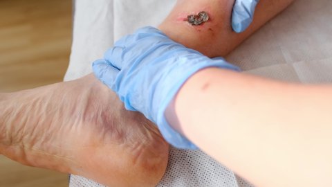doctor treats a large healing wound from a severe burn on the leg of an adult male patient, redness, scarring of the skin, the concept of medical care, human tissue regeneration