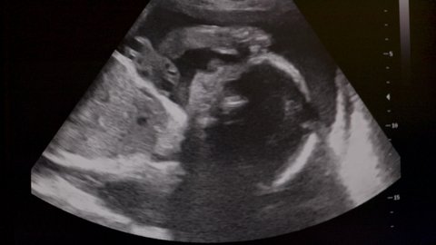 Heart of human embryo on an ultrasound display