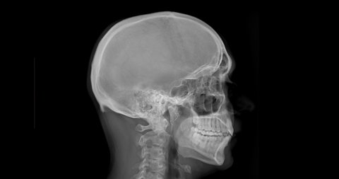 Skull Film Patient Intracerebral Hemorrhage Showing Stock Photo 