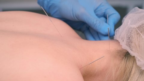 Hands of doctor acupuncturist inserts acupuncture needles to woman's neck, closeup view. Woman patient is lying on couch in hospital. Chinese medicine in European world.