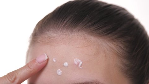 Young skin of the forehead with acne. Getting rid of the rash. Apply a cosmetic remedy for acne rashes with a cotton swab. Hormonal surges in adolescents. Allergy to food. Treatment of the skin with