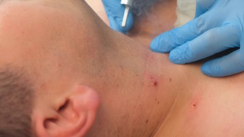 Surgeon removing many small moles using laser on man's neck, burning skin, closeup view. One day surgery concept. Removing papillomas or birthmarks, surgical procedure.