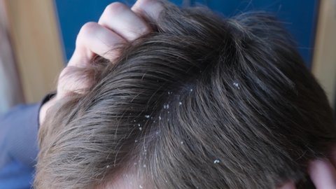 Man scratches his head due to dandruff, close-up